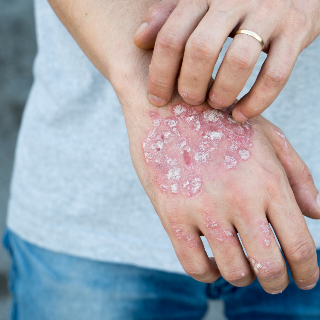 Tips for Living with Psoriasis