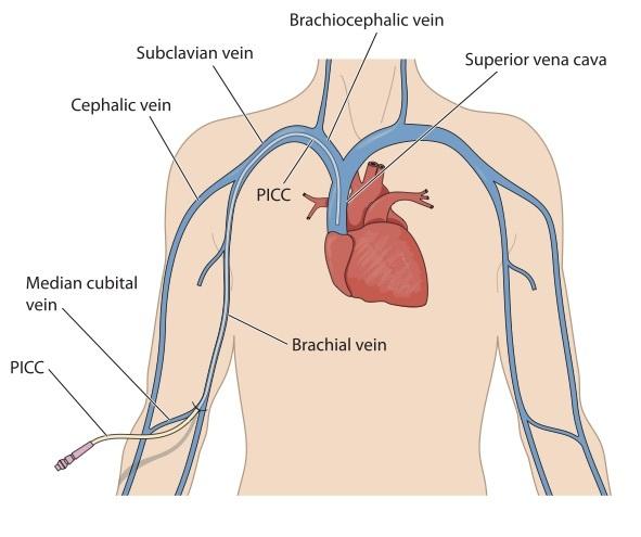 What Is A Picc Line? - Care+Wear